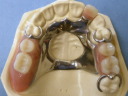 Cast Partial Denture