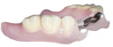 Flexible Denture