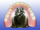 Full Denture Metal