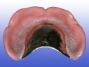 Full Denture Metal