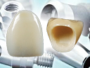 Implant & Zirconia