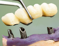 インプラントとメタルボンド冠