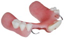 Partial Denture