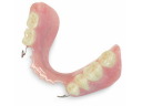 Partial Denture