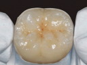 Zirconia Zeramics Crown
